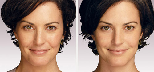 juvederm before after photos san diego
