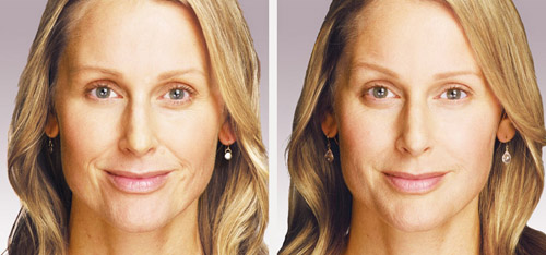 juvederm before after photos san diego