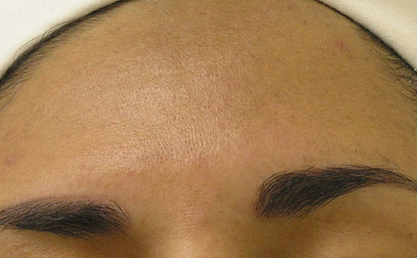 Sun_Damage_Acne_After_4_Treatments