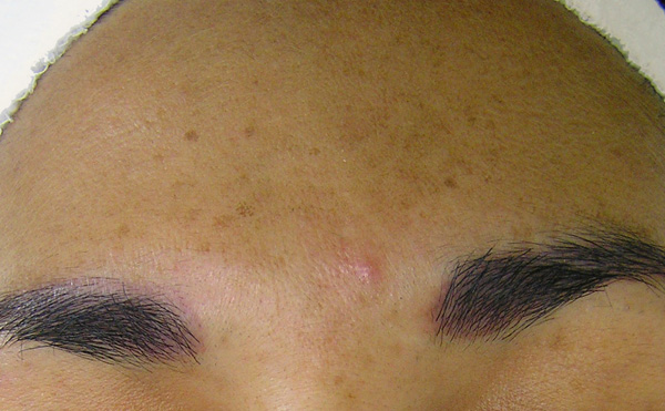 Sun_Damage_Acne_Before-600