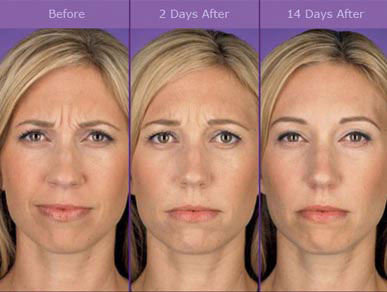 botox san diego before and after