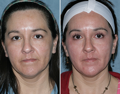 latisse-results-01b-small San Diego Patient