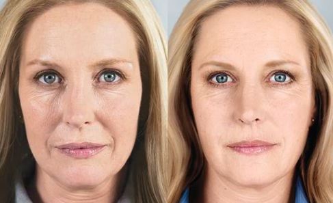sculptra before and after san diego