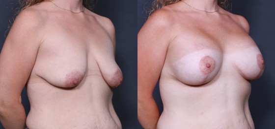 Dr. Roark Breast Augmentation with Lift Patient 1