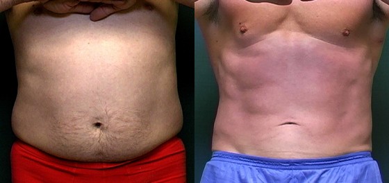 Dr. Roark Male Liposuction Patient 1