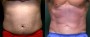 Dr. Roark Male Liposuction Patient 1