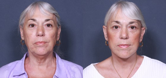 Dr. Brahme Neck Lift Patient 1