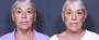 Dr. Brahme Neck Lift Patient 1