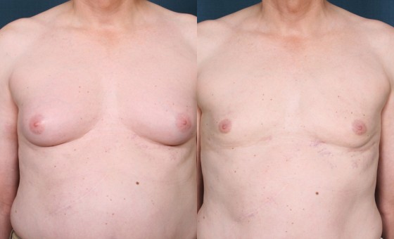 Dr. Roark Male Breast Reduction Patient 1