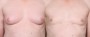 Dr. Roark Male Breast Reduction Patient 1