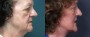 Dr. Brahme Neck Lift Patient 3