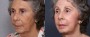 Dr. Brahme Neck Lift Patient 6