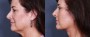 Dr. Brahme Neck Lift Patient 2