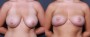 Dr. Roark Breast Reduction Patient 2
