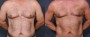 Dr. Roark Male Liposuction Patient 2