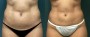 Dr. Roark Liposuction Patient 2