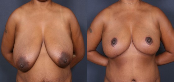 Dr. Roark Breast Reduction Patient 1