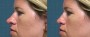 Dr. Roark Rhinoplasty Patient 2