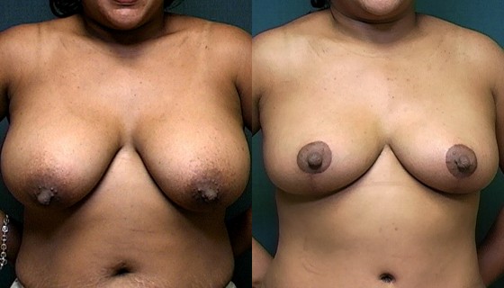 Dr. Brahme Breast Reduction Patient 1