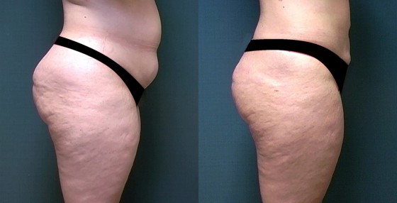 Dr. Roark Liposuction Patient 1