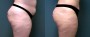 Dr. Roark Liposuction Patient 1