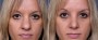 Dr. Roark Rhinoplasty Patient 3
