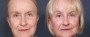 Dr. Roark Neck Lift Patient 6