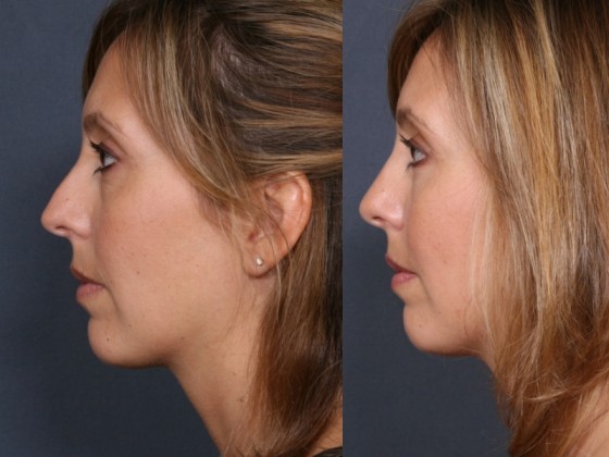 Dr. Roark Rhinoplasty Patient 1