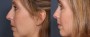 Dr. Roark Rhinoplasty Patient 1