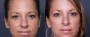 Dr. Brahme Chin Enlargement Patient 2