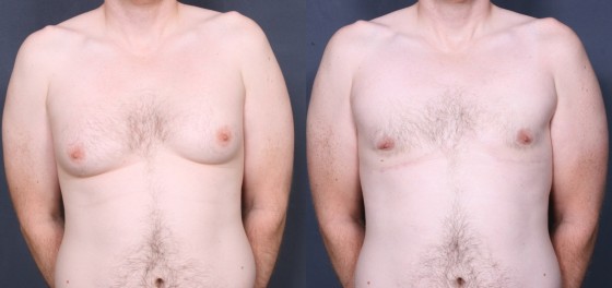 Dr. Brahme Male Breast Reduction Patient 1