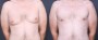 Dr. Brahme Male Breast Reduction Patient 1