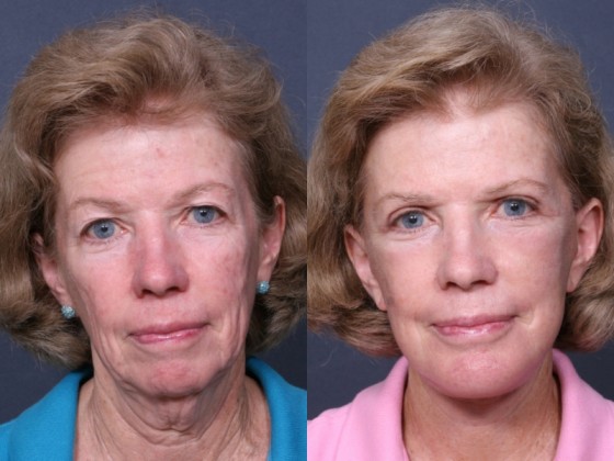 Dr. Brahme Chin Enlargement Patient 1