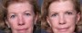 Dr. Brahme Chin Enlargement Patient 1
