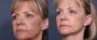 Dr. Brahme Neck Lift Patient 5