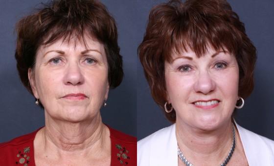 Dr. Roark Chin Enlargement Patient 1