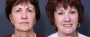 Dr. Roark Chin Enlargement Patient 1