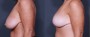 Dr. Saltz Breast Reduction Patient 6