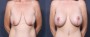 Dr. Brahme Breast Augmentation with Lift Patient 3