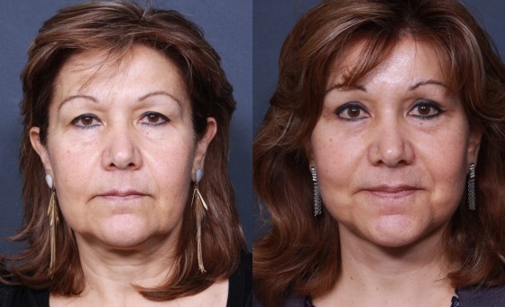 Dr. Brahme Forehead Lift Patient 1