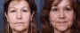 Dr. Brahme Forehead Lift Patient 1