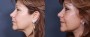 Dr. Brahme Neck Lift Patient 4