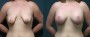 Dr. Roark Breast Augmentation with Lift Patient 4