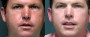 Dr. Saltz Male Liposuction Patient 2