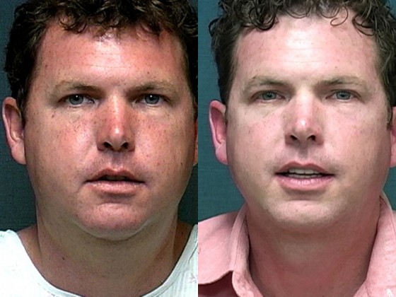 Dr. Saltz Neck Liposuction Patient 1