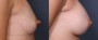 Dr. Brahme Nipple Reduction Patient 1