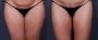 Dr. Saltz Liposuction Patient 5