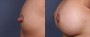 Dr. Saltz Nipple Reduction Patient 1