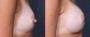 Dr. Saltz Nipple Reduction Patient 3