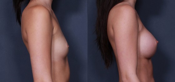 Dr. Saltz Inverted Nipple Patient 1